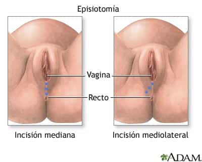 Tipos de incisión en la episiotomia