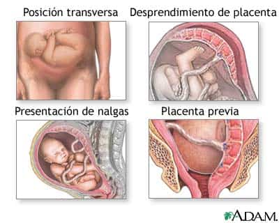 Trastornos que pueden provocar un parto vaginal peligroso para la madre
