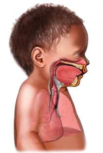 Niños prematuros: propensos a padecer el virus del bebé Área afectada