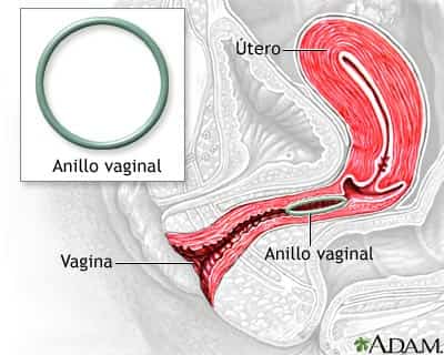 Colocación del anillo vaginal