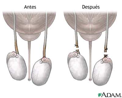 Órganos vasectomizados