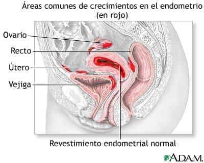 endometriosis-1.jpg