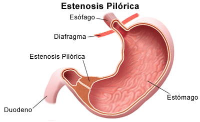 estenosis-pilorica.bmp