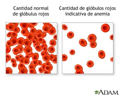 anemia-globulos-rojos