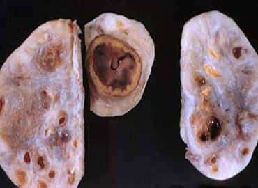 ovario-poliquistico-ntnva