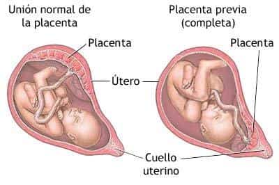 placenta-previa