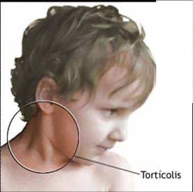 torticolis-congenita