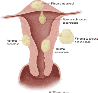 fibroid uterus