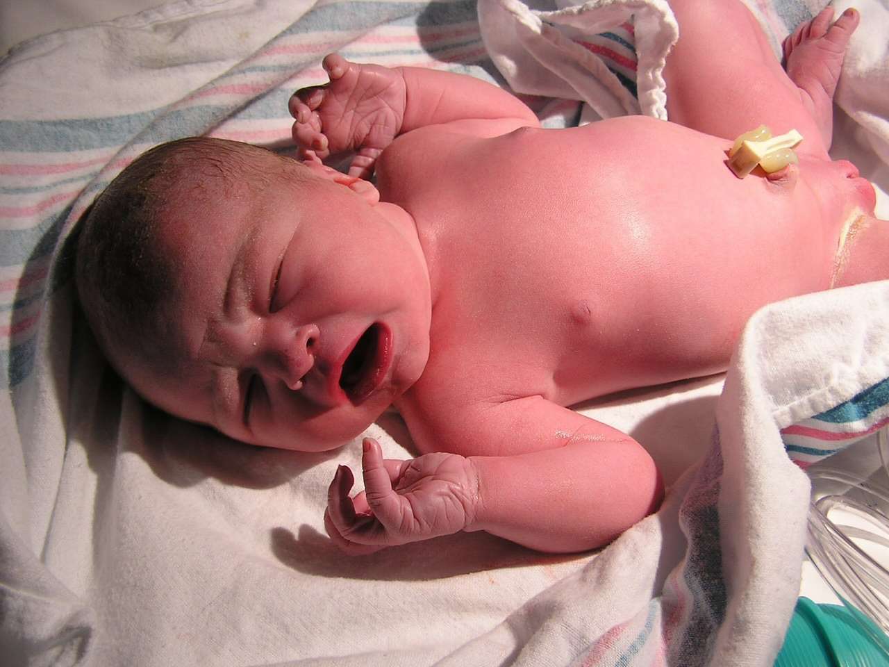 Causas De La Onfalitis En Recien Nacidos