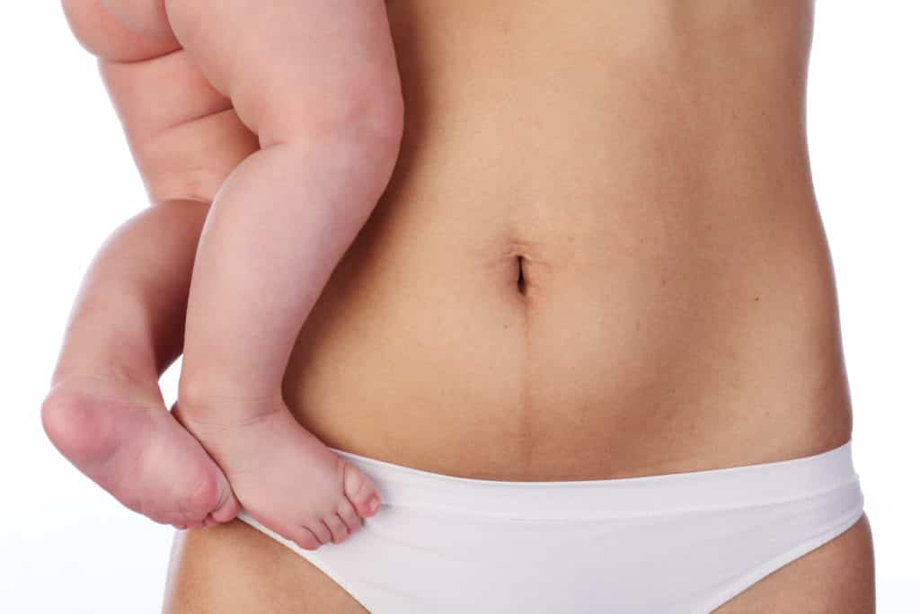 Recuperar la figura previa al embarazo: ¿Qué es el Mommy Makeover?